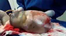بالفيديو: ولادة نادرة لطفل يتحرك داخل سائل الغشاء "السلوي"