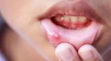 3 طرق طبيعية للقضاء على تقرحات الفم