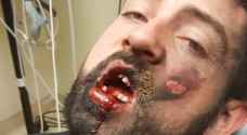 سيجارة الكترونية تفقد شابا أسنانه وتشوه وجهه ..صور