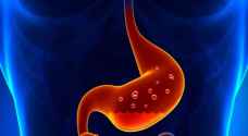 حرقة المعدة متى تصبح خطيرة وقاتلة!