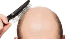 وداعا للصلع.. اختراق طبي يعيد نمو الشعر