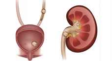 8 خطوات لعلاج حصوات الكلى دون تدخل جراحى