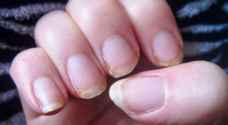 أظافرك وصحتك.. 8 علامات خطيرة "لا تتجاهلها أبدا"