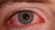 اذا كنتم من الذين يعانون من حساسية العيون في الخريف إليكم الحل- فيديو