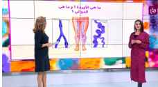 ما هي أعراض دوالي الساقين وكيف نستطيع معالجتها؟ - فيديو