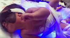 رضيعة ولدت بتصبغات جلدية تبدا رحلة العلاج