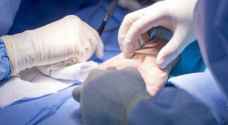 أول عملية جراحية في العالم لزرع كف من شخص إلى آخر