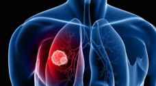 تعرف على أول أعراض سرطان الرئة