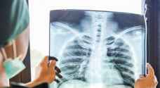 دراسة طبية تزف بشرى سارة لمرضى سرطان الرئة