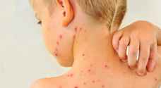 بعد رصد حالات بالحصبة في الأردن.. أطباء يوجهون تحذيرا مهما