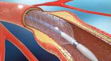 الغذاء والدواء: تحديد سقوف سعرية لملحقات الشبكات القلبية بهدف تخفيض أسعارها